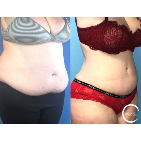 Tummy Tuck Before And After Dr Mark Markarian