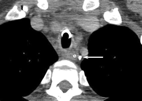 Normal Ct Appearance Of The Distal Thoracic Duct Ajr