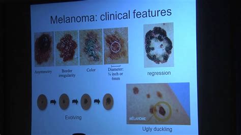 Early Detection Of Melanoma Youtube