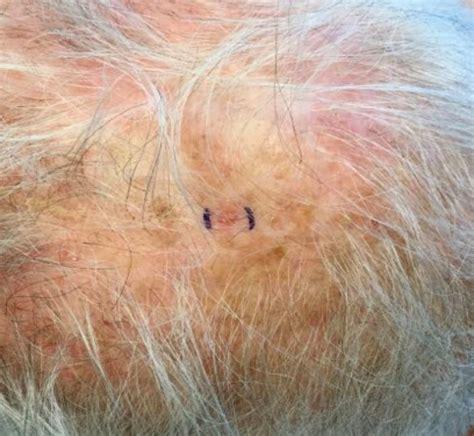 Melanoma Scalp