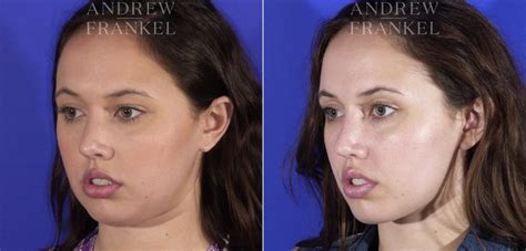 Buccal Fat Removal Photos Beverly Hills Ca Patient 11514