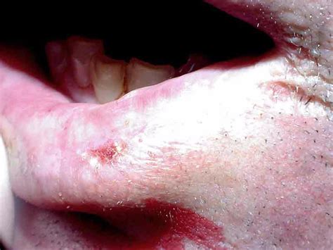 Squamous Cell Skin Cancer Lip