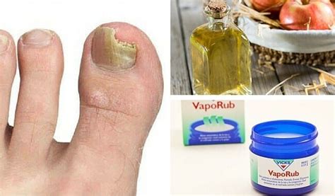 Las 92 Mejores Medicamentos Para Los Hongos De Las Uñas De Los Pies