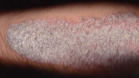 Rash And Skin That Feels Hot To The Touch Causes And Photos
