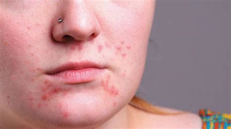 Coping With Adult Acne