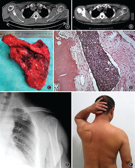 Functional Results And Emotional Acceptance After Scapulectomy For