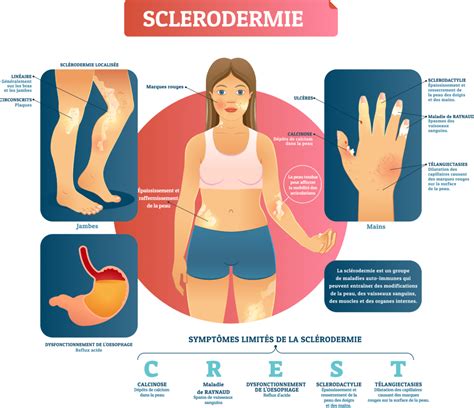Sclérodermie Causes Manifestations Et Traitements Information