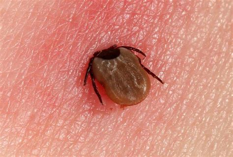 Tick Bite Pictures Appearance Rash Lyme Disease