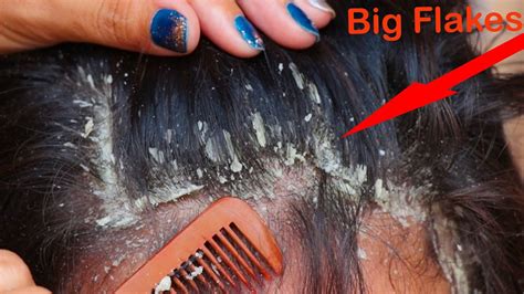 Huge Flakes Itchy Scalp Using Hair Comb Scratching My Sister Youtube