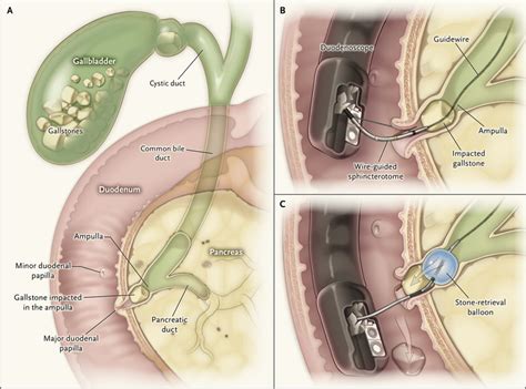 Ercp For Gallstone Pancreatitis Nejm