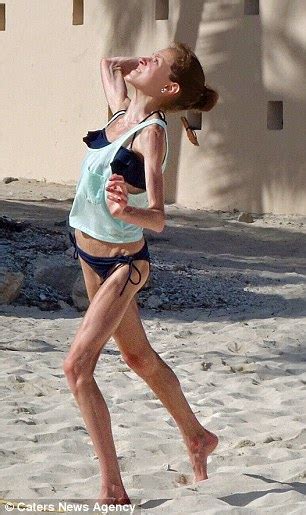 Alice Clarke From Montreal Overcomes Anorexia To Become A Doctor Daily Mail Online