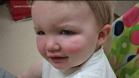 A Toddler Was Rushed To The Emergency Room After An Allergic Reaction