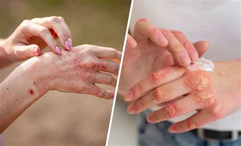 Psoriasis Vs Eczema Difference In Symptoms And Treatment