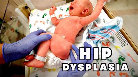 Newborn With Congenital Hip Dysplasia Hospital Visit Dr Paul Youtube