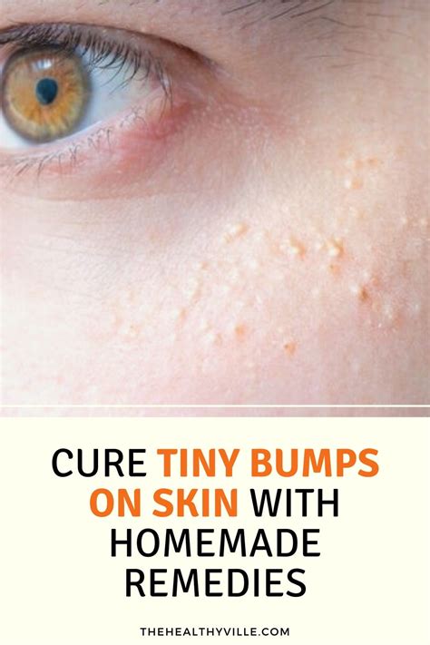 Cure Tiny Bumps On Skin With Homemade Remedies
