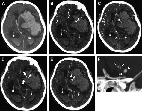 Advanced Ct Imaging In The Evaluation Of Hemorrhagic Stroke Radiology Key