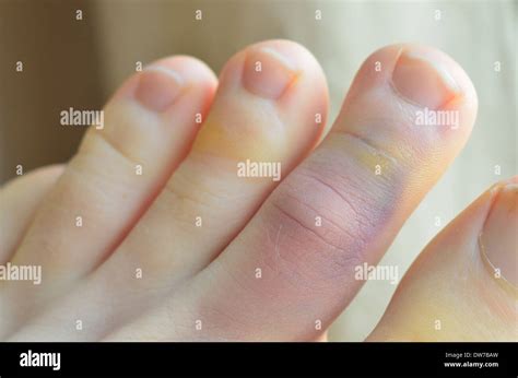 Sprained Toe Left Foot Stock Photo Alamy