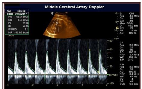 Middle Cerebral Artery Doppler In Weeks Plus Days Postdated