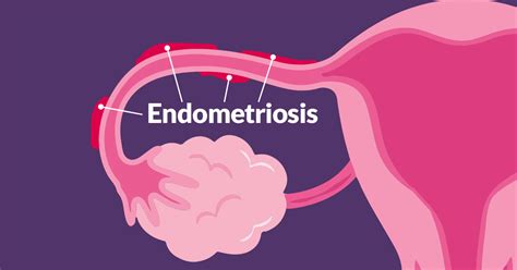 How To Detect Endometriosis Endometriosis Symptoms Diagnosis And