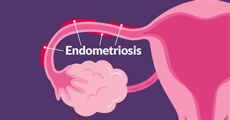Endometriosis can develop in the lower area of the pelvic area and settle in the pouch of douglas. Endometriosis | Creafam