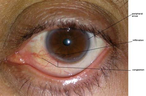 Corneal Infections