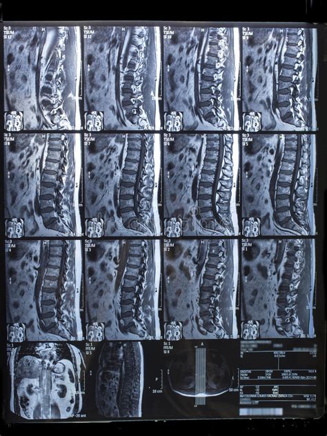 Also, get the scoop on the before we get to 7 herniated disc exercises, let's talk a little about the symptoms and treatment i have ppsterior bulging of l5 s1 in mri. MRI Lumbosacral Column, Hernia Intra-foraminal Right L5-S1 Stock Photo - Image of lumbosacral ...