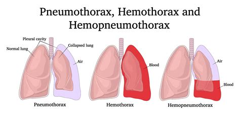 Thoracic Trauma Pneumothorax Copy High Peak First Aid