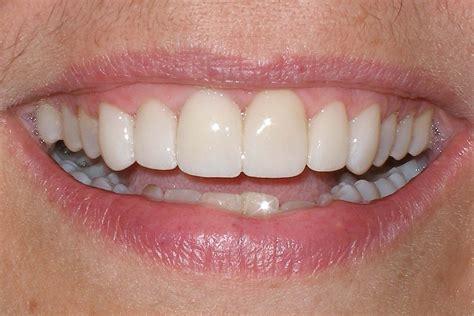 Veneers Smile Gallery Raber Dental Kidron Dentist