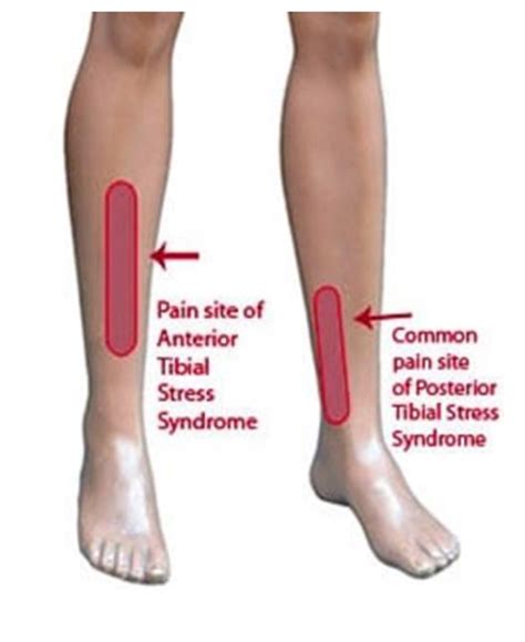 Recognition Treatment And Therapy For Painful Shin Splints — Fit For Life