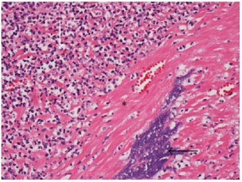 Fusobacterium Necrophorum Wikiprojectmed