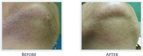 Maybe you would like to learn more about one of these? Hair Reduction Portland - Laser Hair Removal Portland ...