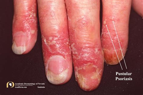 Pustular Psoriasis Lakes Of Sterile Pustules Academic Dermatology