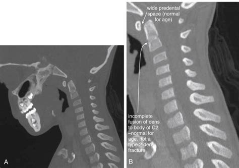 Imaging The Cervical Thoracic And Lumbar Spine Radiology Key