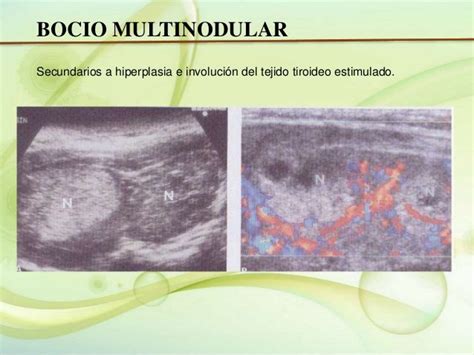 Ecografia De Tiroides Tiroides Bocio Multinodular Bocio