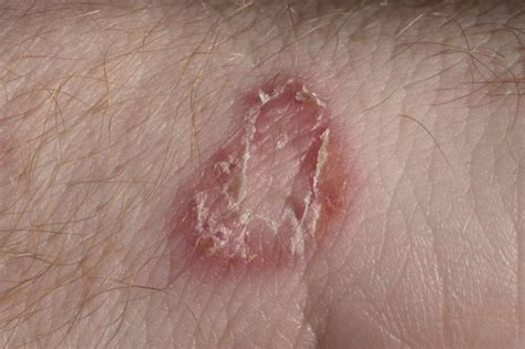 Symptoms And Treatments Of Tinea Cruris Facty Health