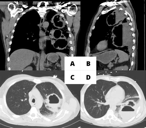 Large Lung Abscesses Managed With Percutaneous Drainage Published In