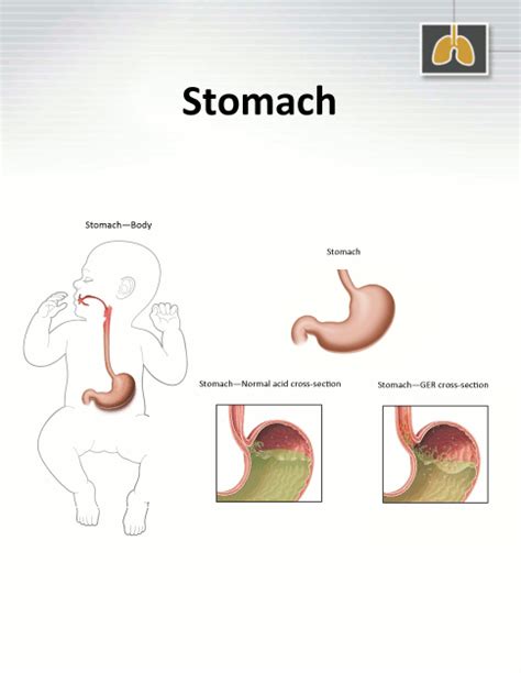 Stomach Nicu Parent Education Resources