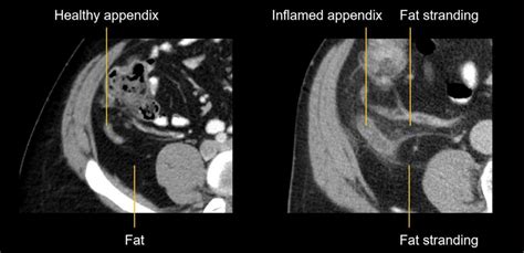 Abdominal CT Common Terms LITFL Radiology Library