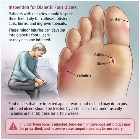 Diabetic Foot Ulcers Neurology Jama Jama Network Ulcers Diabetic Feet Medical Knowledge