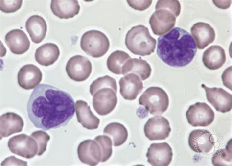 Adult T Cell Leukemia Lymphoma
