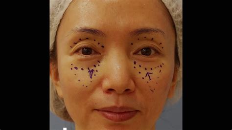 Fat Grafting To Lower Eyelid Youtube