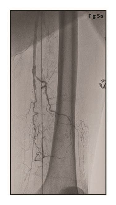 Angiogram Obtained Using Antegrade Left Superficial Femoral Artery