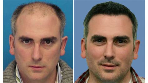 For example, while nhs does not. Hair Transplants in the UK- What To Do Before and What To Expect After