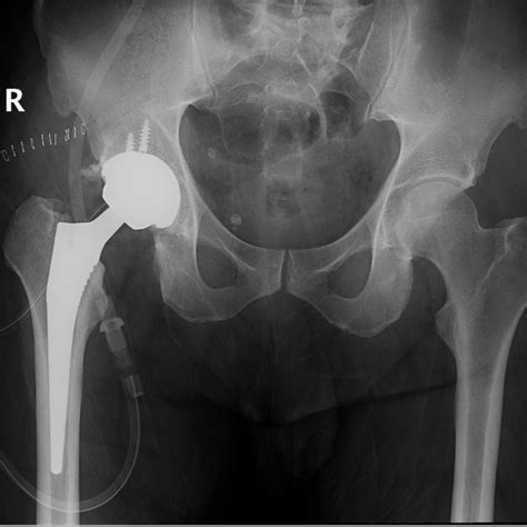 Total Hip Replacement Dr Mohamed Attia M D Phd