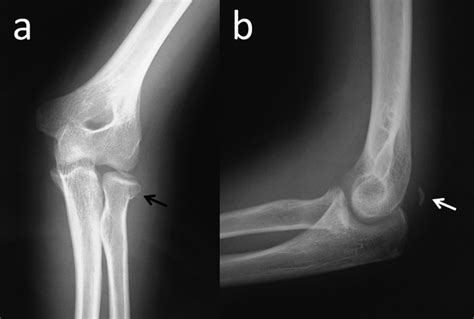 Triceps Tendon Avulsion And Associated Injuries Of The Elbow Bmj Case