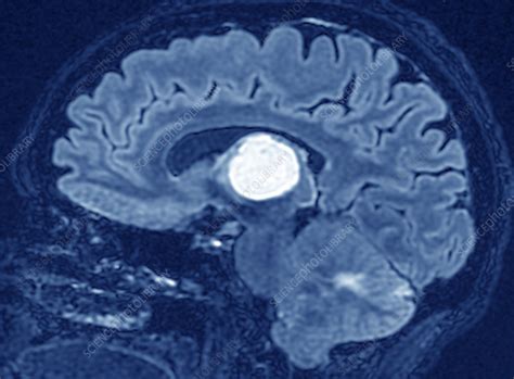 Secondary Brain Cancer Mri Scan Stock Image C0473422 Science