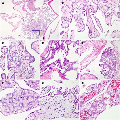 Clinicopathological Characteristics Of Well Differentiated Papillary