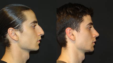 male rhinoplasty may 2016 02 before after dr shahidi