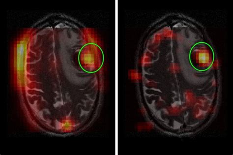 New Imaging Technique Provides Snapshot Of Brain Tumor Activity