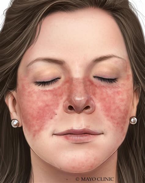 Lupus Symptoms Causes Mayo Clinic
